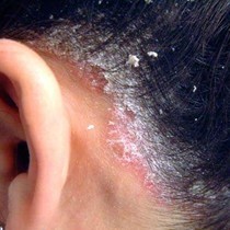 Lotions for scalp psoriasis