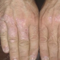 Creams for Psoriasis